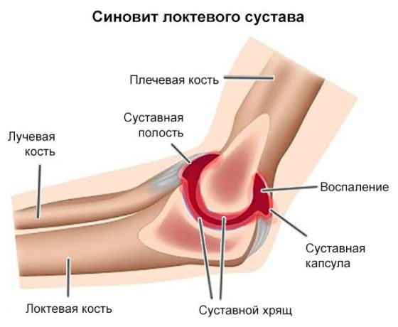 Русвиск помогает убрать воспаление в суставе и восстановиться хрящу