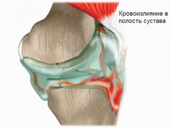 При гемоартрозе применять Гиастат запрещено