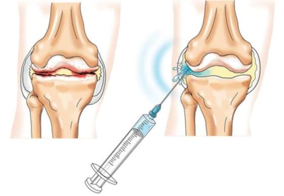 Синокром вводят внутрь поврежденного сустава