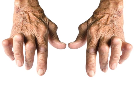 Иммард предотвращает обострение ревматоидного артрита