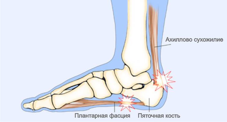 Места образования пяточной шпоры