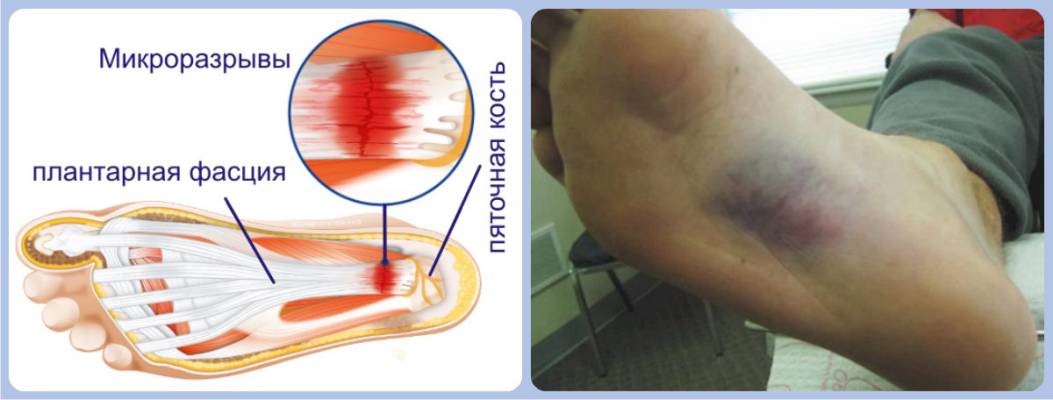 Микроразрывы в плантарной фасции и образование гематомы