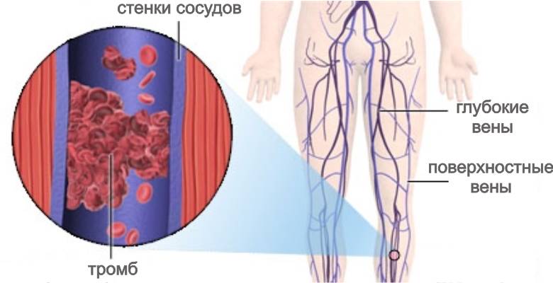 Тромбофлебит - абсолютное противопоказание к операции