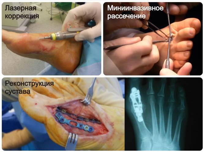 Виды оперативного вмешательства при косточке на ногах
