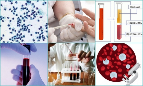 Анализ крови для определения ревматизма
