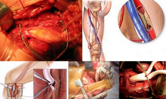 Аорто-бедренное шунтирование при атеросклерозе сосудов
