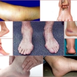 Артрит голеностопа – внешние данные патологии