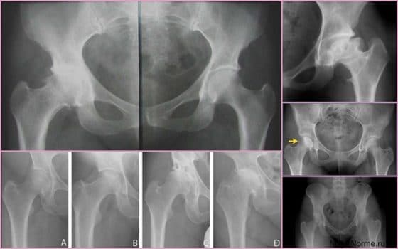 Артрит тазобедренного сустава на рентгене
