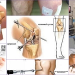 Артроскопия колена – проведение операции