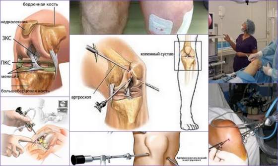 Артроскопия колена – проведение операции