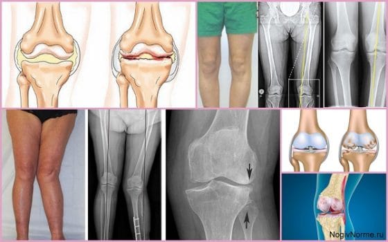 Артроз 3 степени коленного сустава