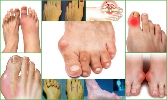 Артроз большого пальца ноги – методы лечения