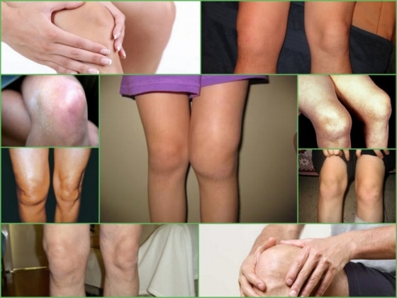 Артроз коленного сустава – внешние проявления