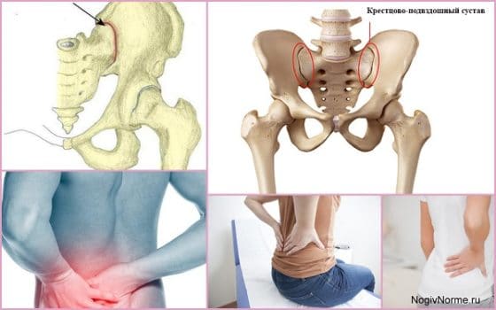 Артроз крестцово-подвздошных сочленений