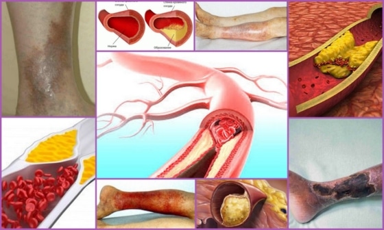 Атеросклеротические бляшки в сосудах