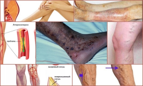 Атеросклероз сосудов на ногах – проявления