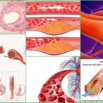 Атеросклероз сосудов – развитие патологии