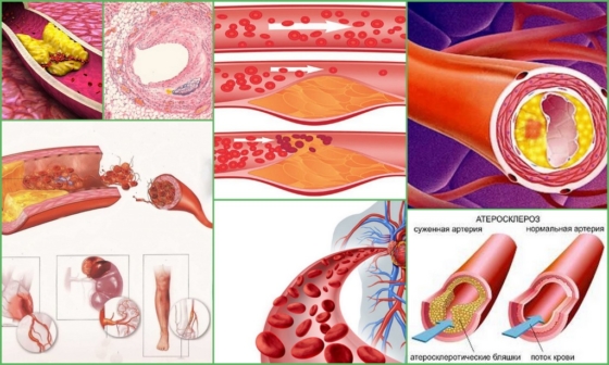 Атеросклероз сосудов – развитие патологии