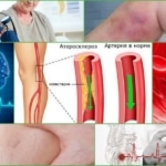 Болезни, при которых требуется разжижение крови