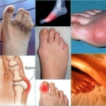 Болезни, вызывающие боль в суставах пальцев ног