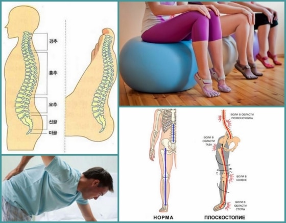 Боли в спине из-за плоскостопия