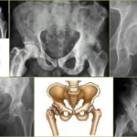 Дефартроз тазобедренного сустава