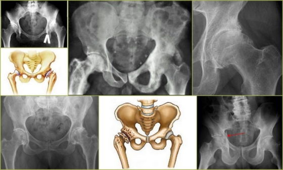 Дефартроз тазобедренного сустава