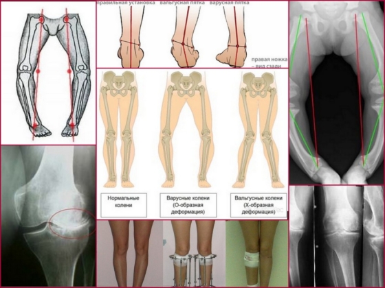 Вальгусная и варусная деформация коленных суставов у взрослых и детей