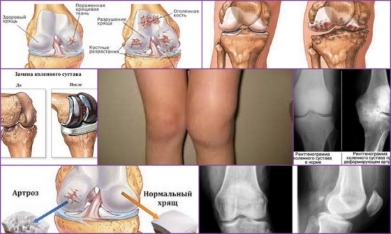 Деформирующий артроз колена – внешние характеристики