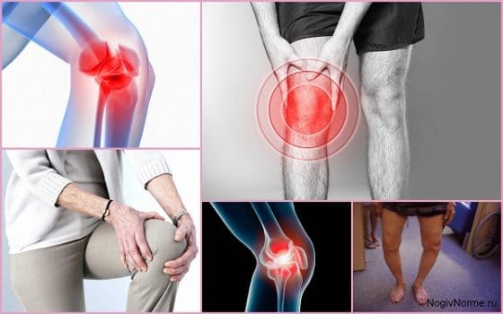 Деформирующий артроз коленного сустава 