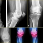 Деформирующий остеоартроз на рентгенографии