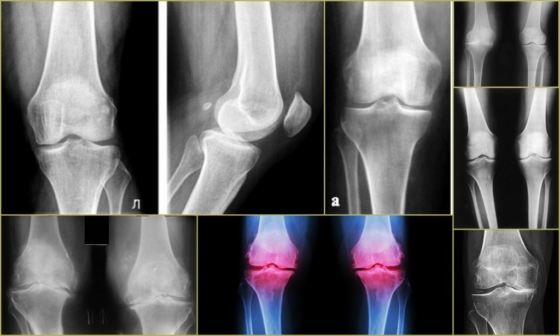Деформирующий остеоартроз на рентгенографии