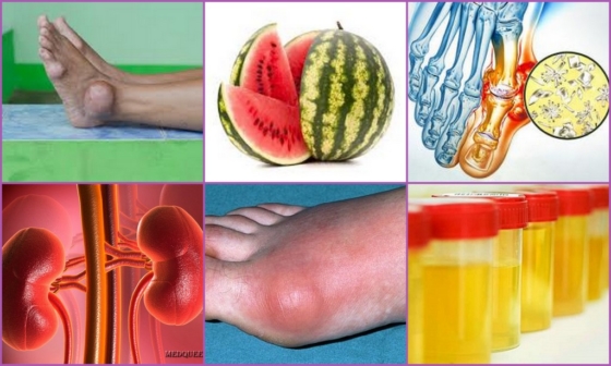 Действие арбуза при подагре
