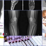 Диагностические методики для определения артрита колена