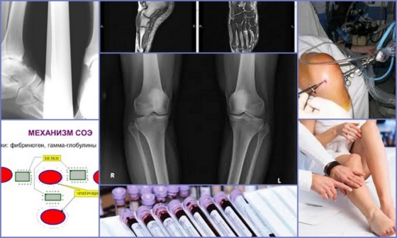Диагностические методики для определения артрита колена