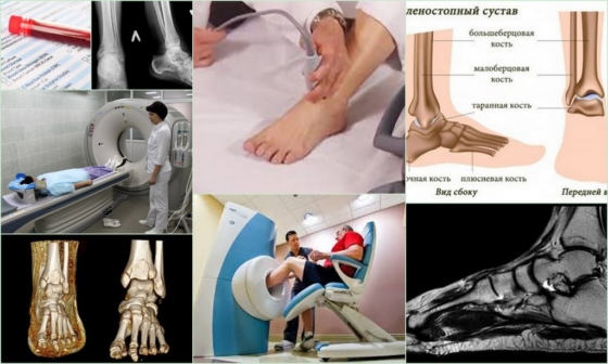 Диагностические методы артрита голеностопа