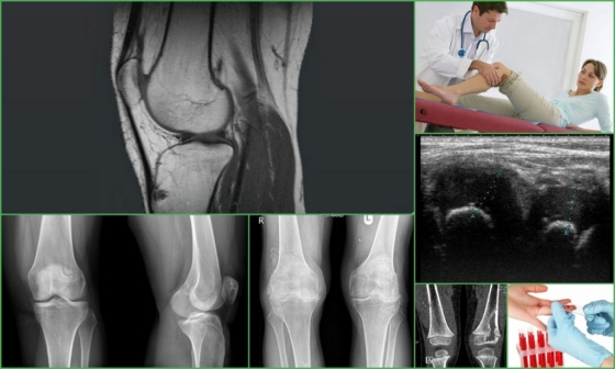 Диагностика артрита колена – определение болезни