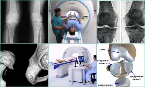 Диагностика артроза 3 степени