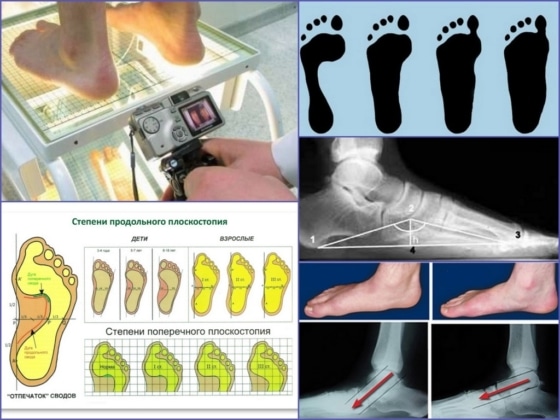 Диагностика и степени плоскостопия