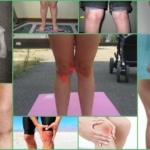 Дисплазия колена – внешние проявления