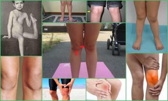 Дисплазия колена – внешние проявления