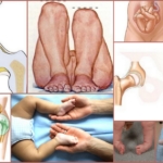 Дисплазия тазобедренных суставов – особенности ее проявления