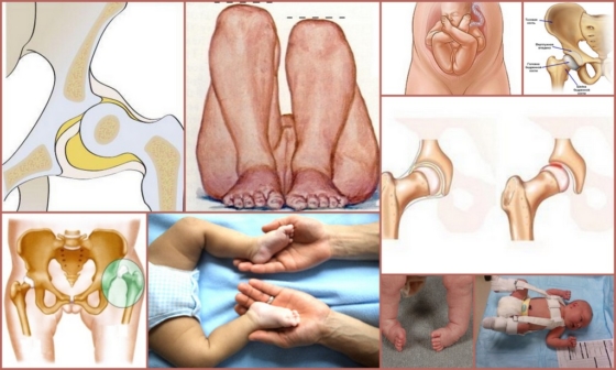 Дисплазия тазобедренных суставов – особенности ее проявления