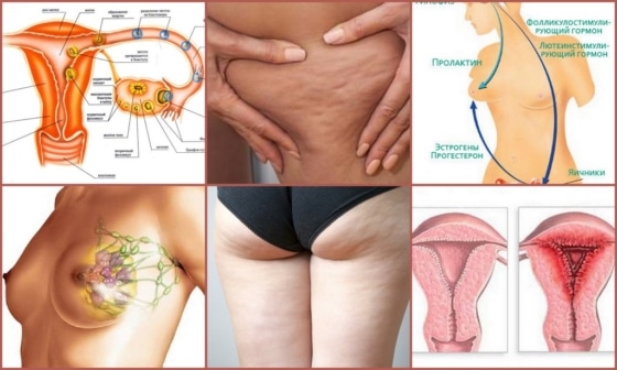 Влияние пролактина и прогестерона на образование целлюлита