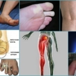 Патологические причины онемения правой ноги
