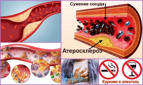 Закупорка сосудов холестериновыми бляшками при атеросклерозе