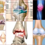 Формы и стадии остеоартрита на ногах