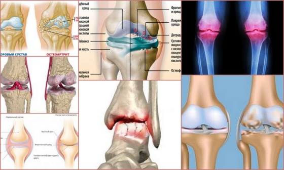 Формы и стадии остеоартрита на ногах