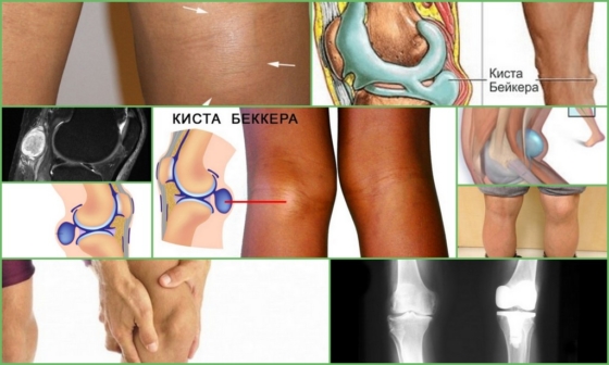 Гигрома Бейкера – внешние проявления патологии