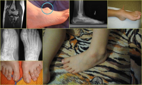 Гигрома на ноге у ребенка – внешние проявления и рентген